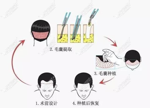 孙公平医生微针植发过程