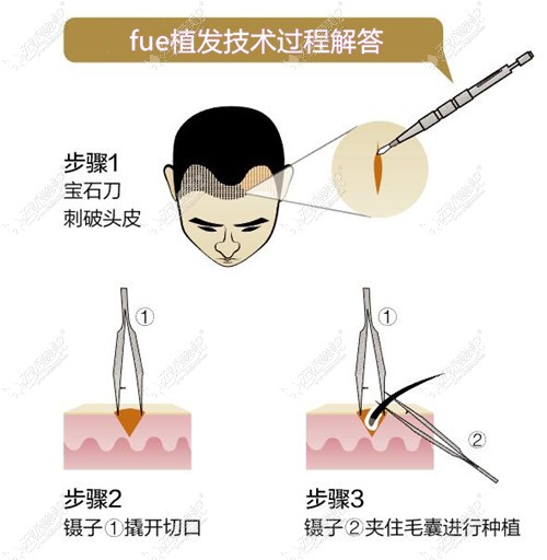 fue植发技术