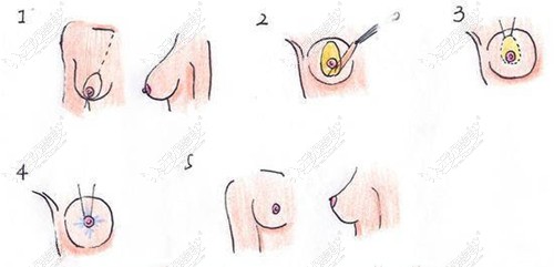 双环法乳房上提过程