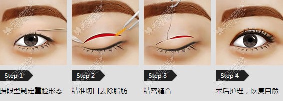 切开双眼皮实操图