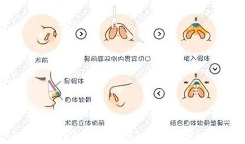 半肋鼻的原理