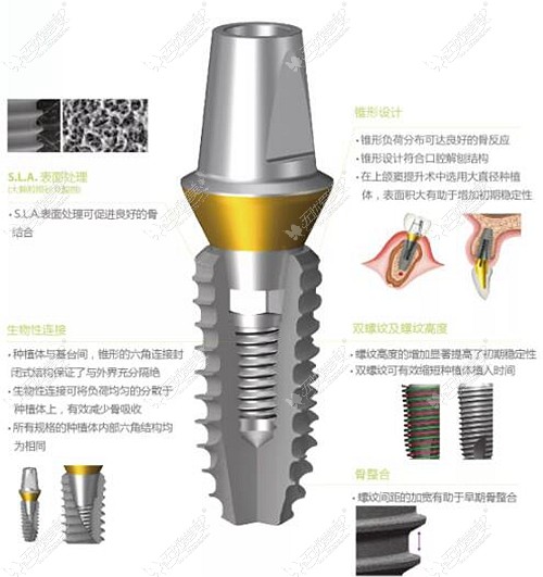 韩国登腾种植体好不好