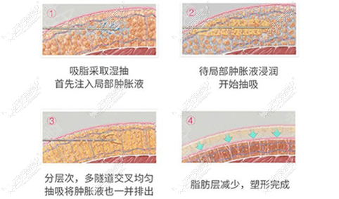 腰部吸脂原理