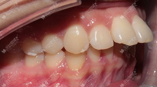 门牙龅牙医生建议磨小戴牙套矫正,可磨小的牙寿命会变短吗?