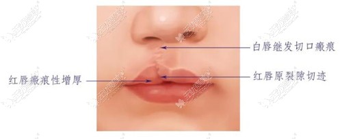 唇腭裂疤痕修复手术需要多少钱取决于你选择哪种方法去除