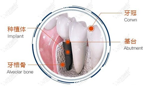 种植牙的组成部位