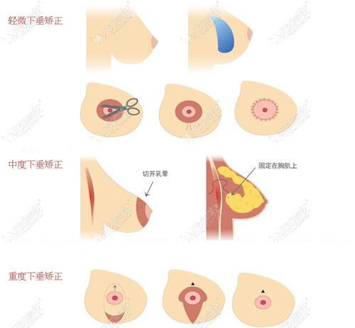 乳房下垂矫正术原理