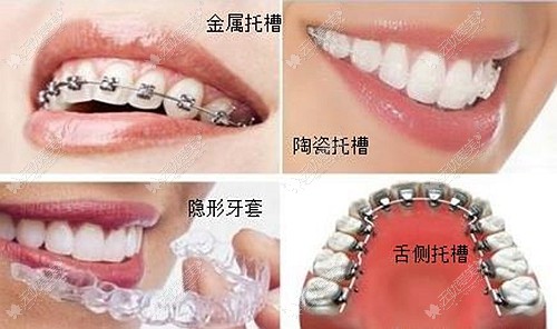牙套的不同类型