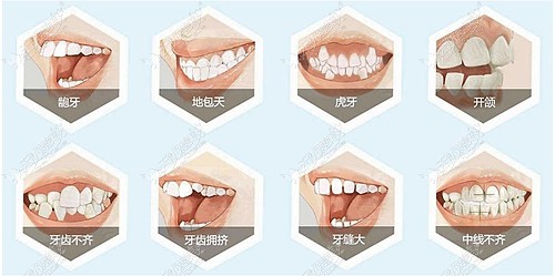 牙齿矫正的多种类型