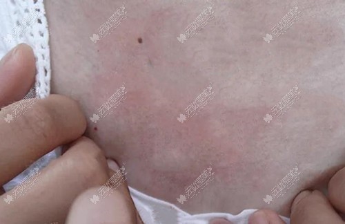 胸前疤痕疙瘩治疗前后图片对比