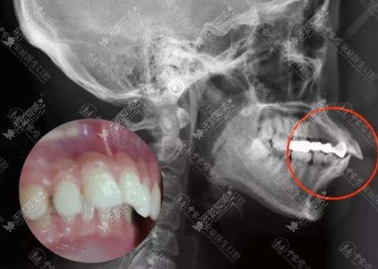 骨性龅牙正畸前图片