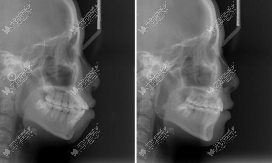 骨性龅牙内收7毫米前后对比图片
