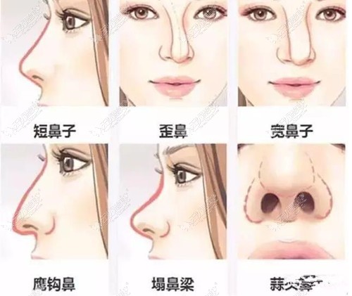 鼻子的不同类型