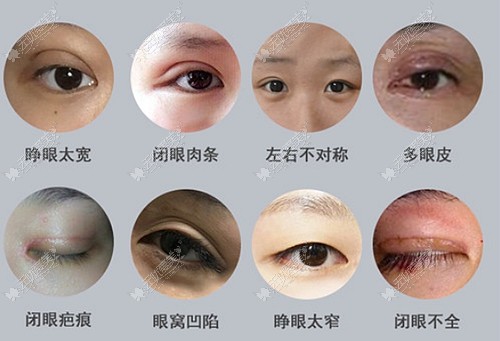 刘月更医生做修复双眼皮的优势