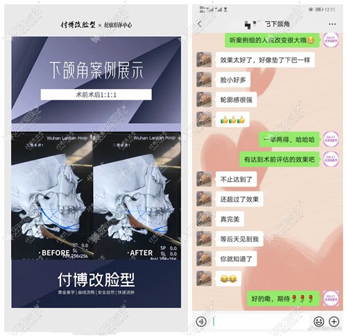 武汉华美有付国友的下颌角截骨图,来瞅付博改脸型技术咋样