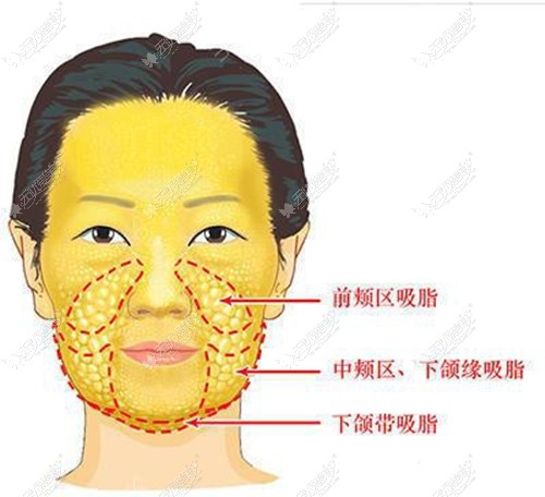 面部吸脂的部位