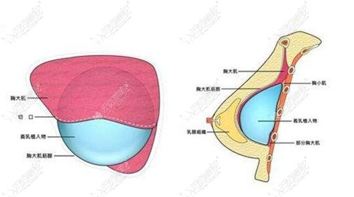 崔东隆胸技术口碑是真好