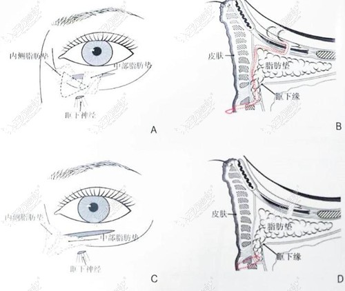 问哈尔滨做眼袋哪做得好,不如来看哈尔滨双燕做眼袋怎么样