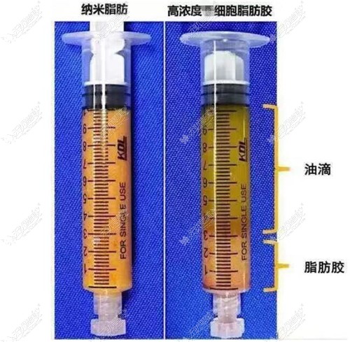 脂肪胶填充的优势