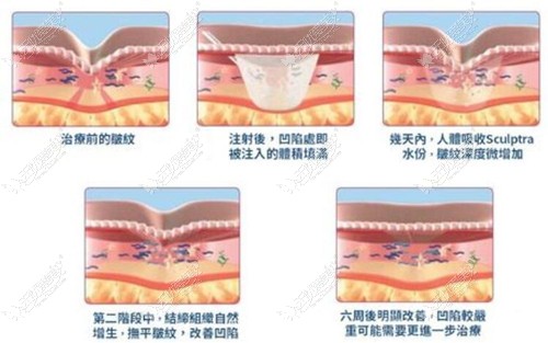 注射胶原蛋白后的变化