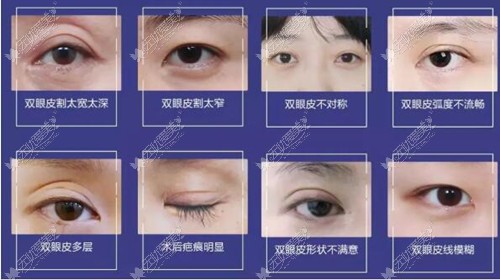 找杭州有名的双眼皮整形医生宋建良修复双眼皮要多少钱呢?