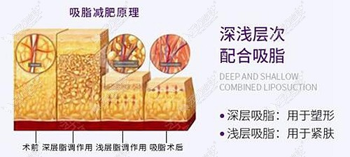 徐州华美做大腿吸脂的技术怎么样？看价格是怪便宜的