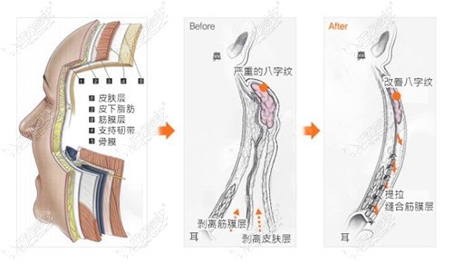 筋膜提升的原理