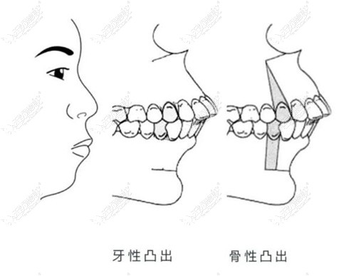 做骨性凸嘴手术过程痛苦吗,看清楚怎么矫正后还是能接受的