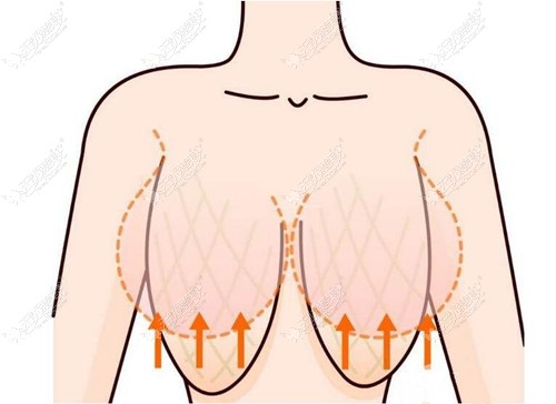 胸下垂做乳房双环悬吊去皮后还会下垂吗?看前后对比图解答