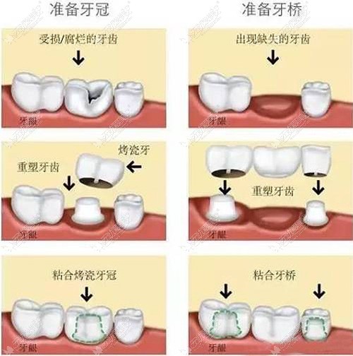 烤瓷牙的过程