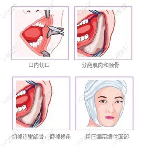 磨下颌角的口内切口