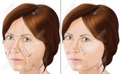 面部提升手术部位分布图