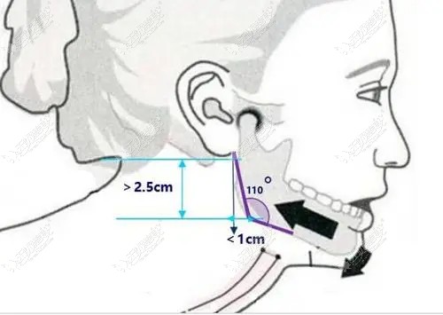 耳根到下颌角距离5cm长的国字脸型做削骨手术后脸会塌吗？