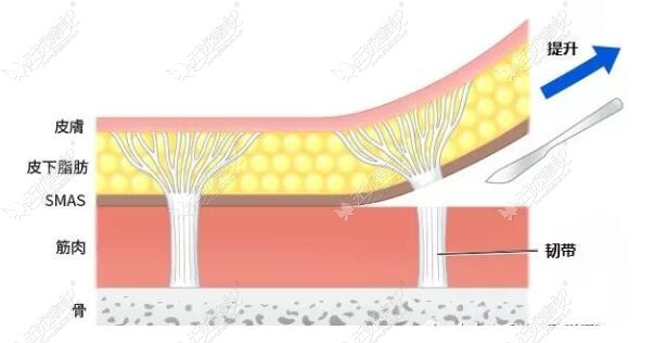 smas筋膜提升手术能维持几年