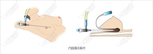 内窥镜隆胸手术过程