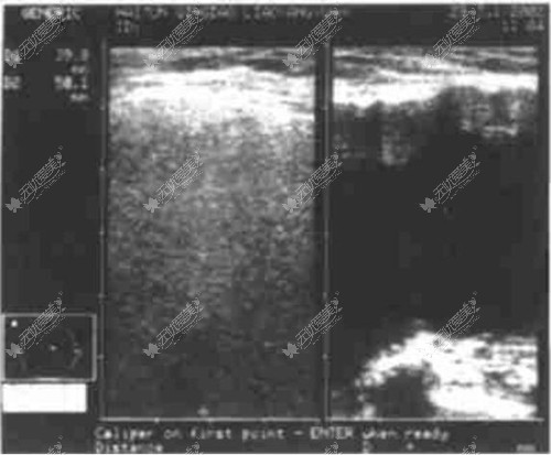 B超下显示的隆胸假体破裂