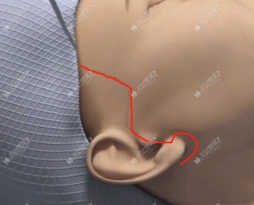 中下面部拉皮手术切口位置图