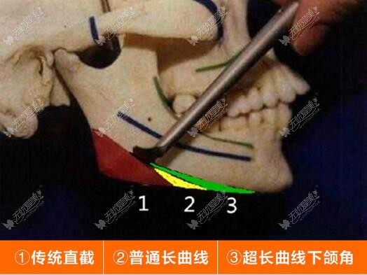 广州广大下颌角磨骨术式特色