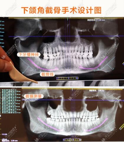 下颌角截骨手术设计图