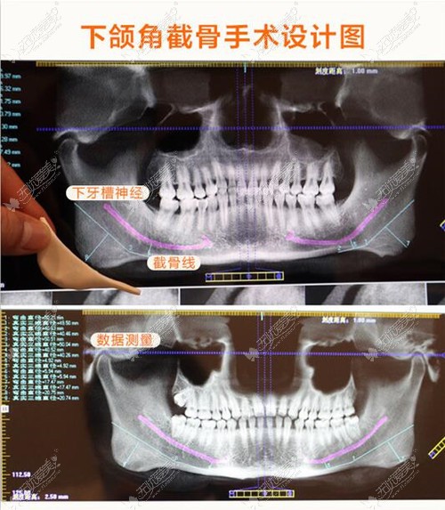 下颌角截骨示意图