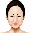 穆宝安v6面部提升实例:做了v美减龄后脸颊没出现凹陷挺平整术前