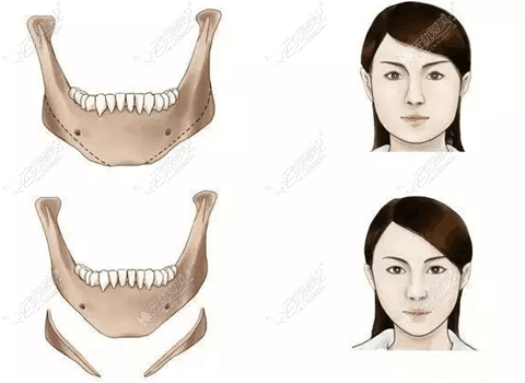 三个半月长曲线下颌角截骨图片证实:脸型改变大骨头没长出