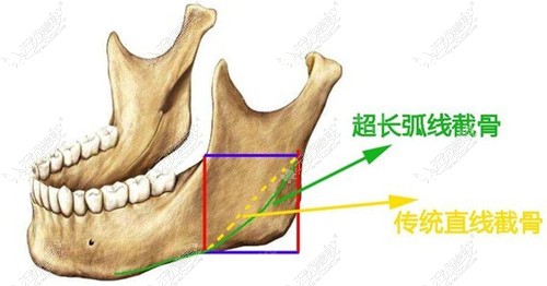 崔宇景下颌角截骨技术