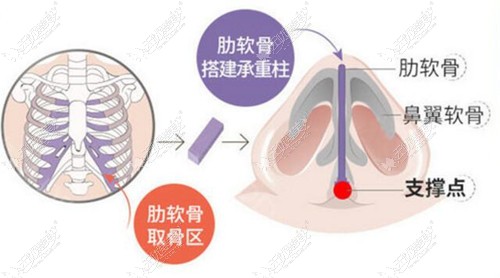 杨季涛做肋骨鼻技术原理