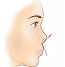 成都铜雀台周柯医生鼻修复实例:全肋鼻感染花5万多就修好了
