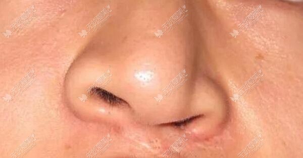 余文林医生做唇腭裂鼻畸形修复的优势