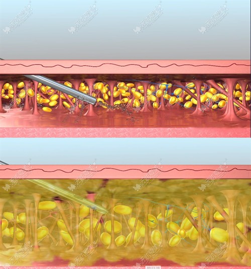 超脂塑吸脂原理
