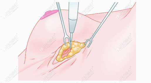 棉花糖丰胸切口
