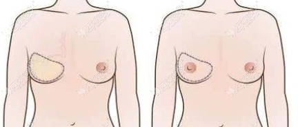 乳房再造术前后对比图