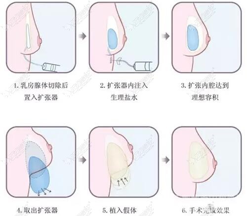 乳房再造术流程